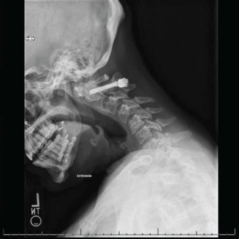 Fracture of C2 pedicles shown with white arrows. Sagittal view (a) and ...