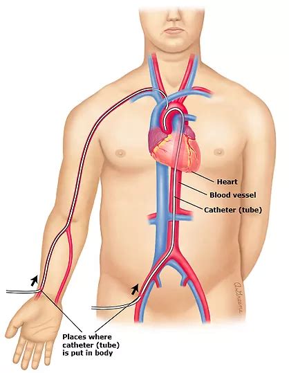 Coronary Angiogram - Cardiology Tasmania