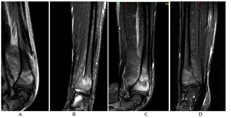 Assessment of the dynamics of bone edema in fractures of long tubular ...