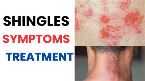 Herpes Zoster (Shingles) Symptoms, Treatment, Vaccine, Contagious, Rash ...