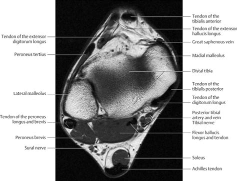 Foot Muscles Mri : Ankle Mri Anatomy Youtube : .magnetic resonance ...