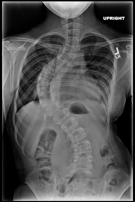 Scoliosis x ray | Scoliosis | Pinterest