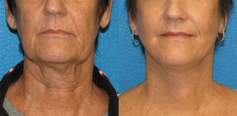 8 Tips for Recovering from a Neck Lift | Torrance Neck Lift | Awaken ...