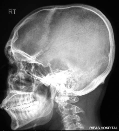 Basal Skull Fracture