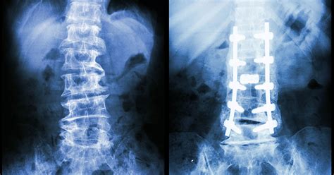 Lumbar Pedicle Screw Fixation (CD Horizon Sextant System) | Scottsdale ...