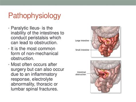 Paralytic ileus