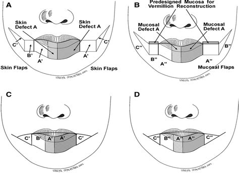 Modified Bilateral Neurovascular Cheek Flap: Functional Reco ...