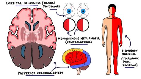 Cerebral Artery Occlusion Pathophysiology - mapasgmaes