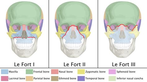 Simple Skull Fracture