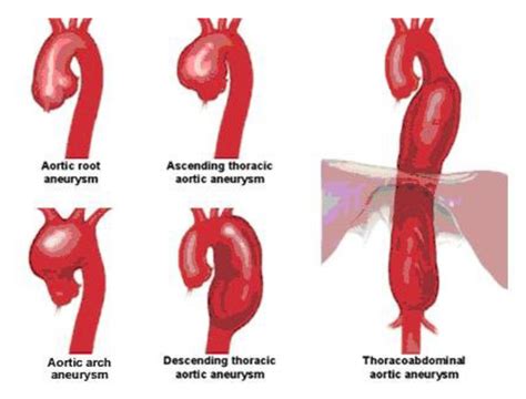 Aortic Aneurysm and Dissection Repair | Patient Care