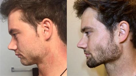 30 Day Face Transformation (Mewing + Fasting) | Connor Murphy - YouTube