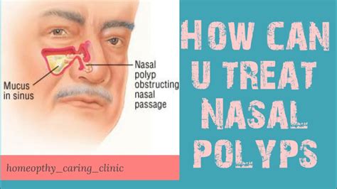 Nasal polyps, symptoms, prevention, Investigations , and some ...