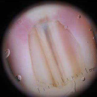 (PDF) Longitudinal melanonychia: detection and management of nail melanoma.