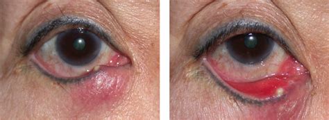 ﻿Eyelid Infections - Warwar Eye Group