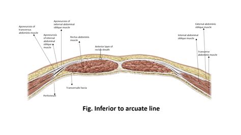 [Solved] Below are two diagrams of the anterior abdominal wall ...