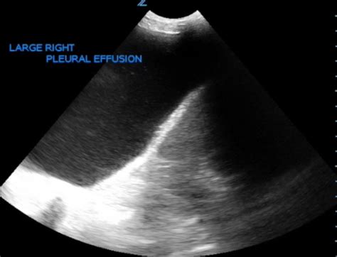 Large Right Pleural Effusion - JETem