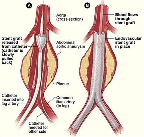 Iliac Artery - Common iliac artery, Internal & External iliac artery ...