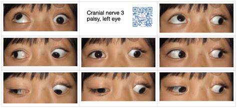 Cranial Nerve Palsy | 3rd nerve palsy | 4th nerve palsy | 6th nerve palsy