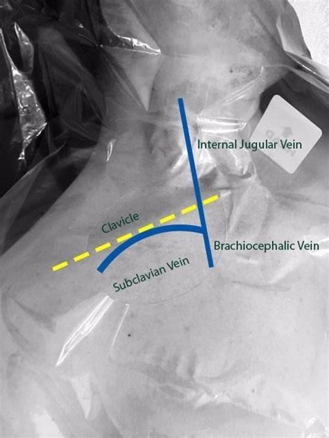 Tips and Tricks: US-Guided Subclavian Vein | EM Ultrasound Section