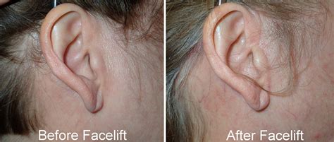 Facelift Incisions & Scars Richmond VA | Hidden Facelift Scars