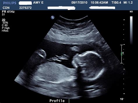 Pretty Babies: Post-Ultrasound Baby Update