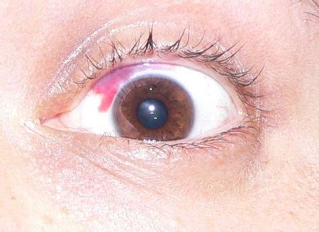 Subconjunctival hemorrhage - WikEM