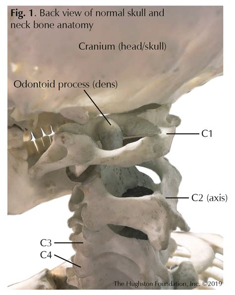 Odontoid Fractures - Hughston Clinic