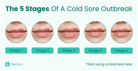 Cold Sores (HSV-1): Stages, Treatments and Prevention