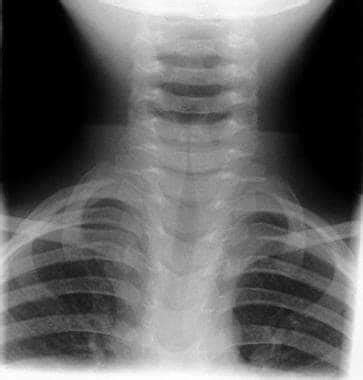 Spasmodic Croup Treatment - Get Images