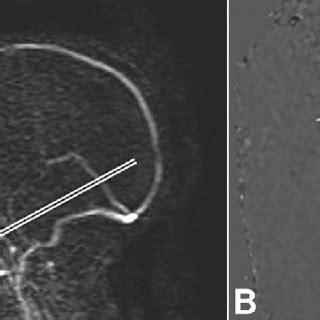 Phase Contrast MRI. Sagittal 2D phase contrast image (A) to illustrate ...