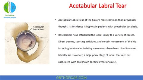 Acetabular Labral Tear | OrthoFixar 2024