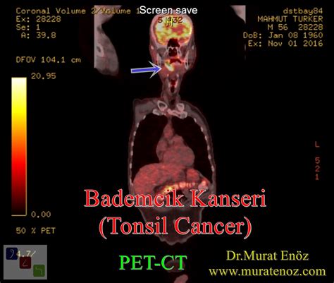 Tonsil Cancer - Causes, Symptoms, Diagnosis and Treatment