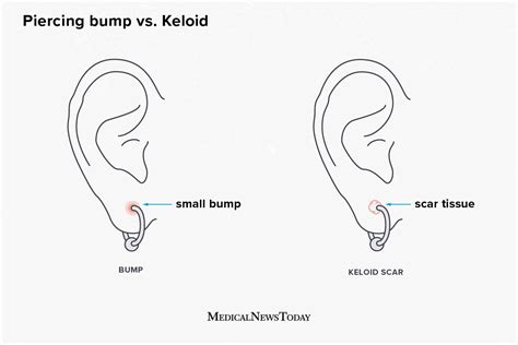 Piercing bump vs. keloid: How to tell the difference and what to do