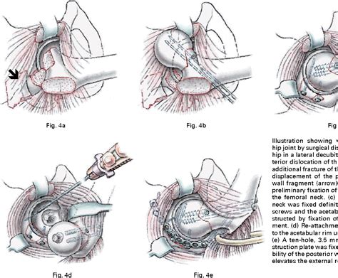 Figure 3 from Surgical dislocation of the hip for a locked traumatic ...