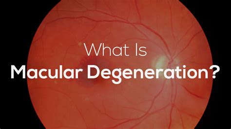 Macular degeneration - Age related, Causes, Types, Symptoms, Treatment