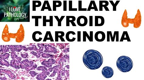 Papillary Carcinoma