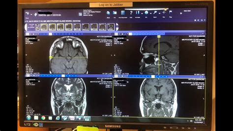 Is anyone able to read an MRI? I’ve shown this to two Endocrinologist’s ...