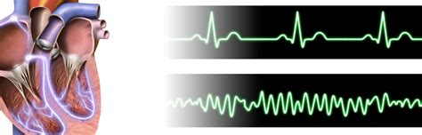 Ventricular Fibrillation Treatment and Causes | ACLS.com Resources