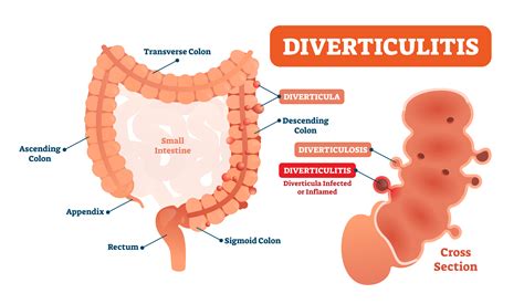 Are Diverticular Disease Treatments Overused? | The Oldish®