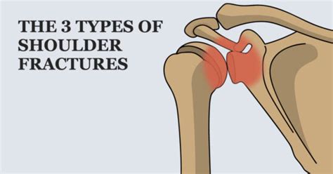 Types of Shoulder Fractures – Welcome to SYS Medtech International Pvt ...