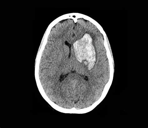 Intracerebral Haemorrhage Photograph by Zephyr/science Photo Library ...