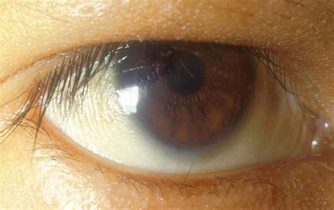 Conjunctival xerosis. Note the slight wrinkling of the temporal ...