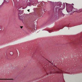 Cementoblastoma Histology