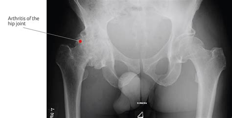 Osteoarthritis of the Hip and how hip pain is treated at SSC.