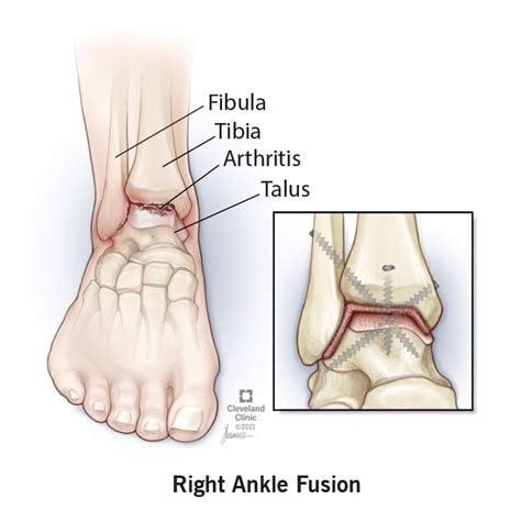 Ankle Fusion Surgery: Procedure, Treatment & Recovery