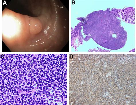 An Unusually Located Colonic Mass - Gastroenterology