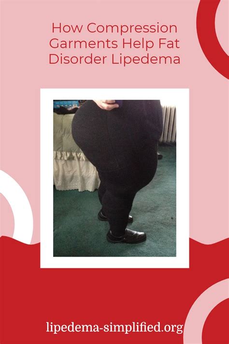 How compression garments help fat disorder lipedema – Artofit