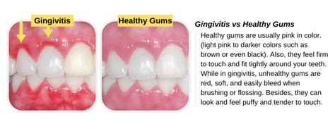 Gingivitis vs Healthy Gums - Share Dental Care