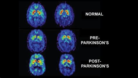 Unlocking Parkinson’s Disease