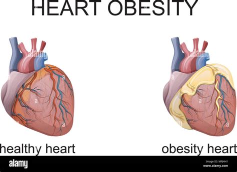 illustration of obesity heart. comparison. cardiology. vector Stock ...